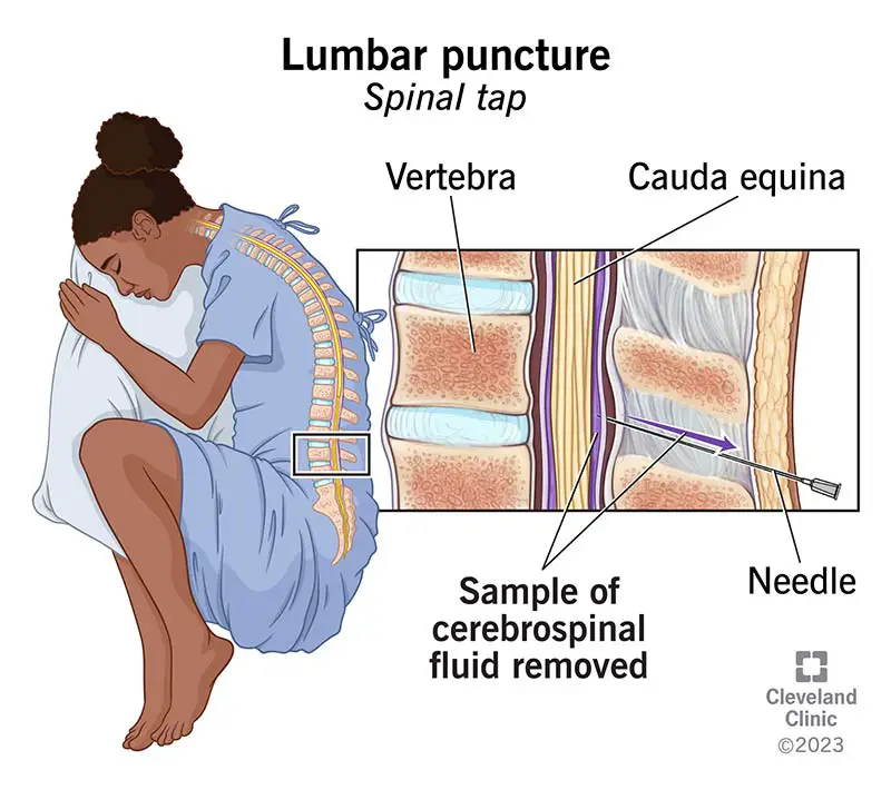 12544 lumbar puncture spinal tap