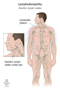 1710271214 15219 swollen lymph nodes