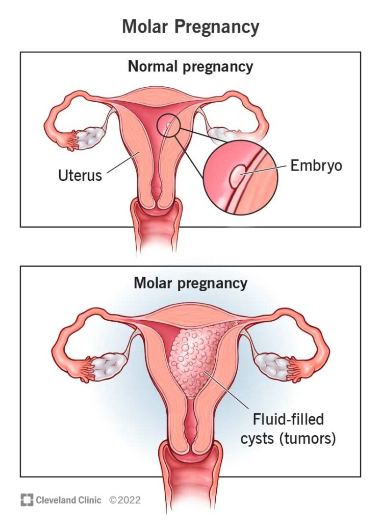 1710275113 17889 molar pregnancy