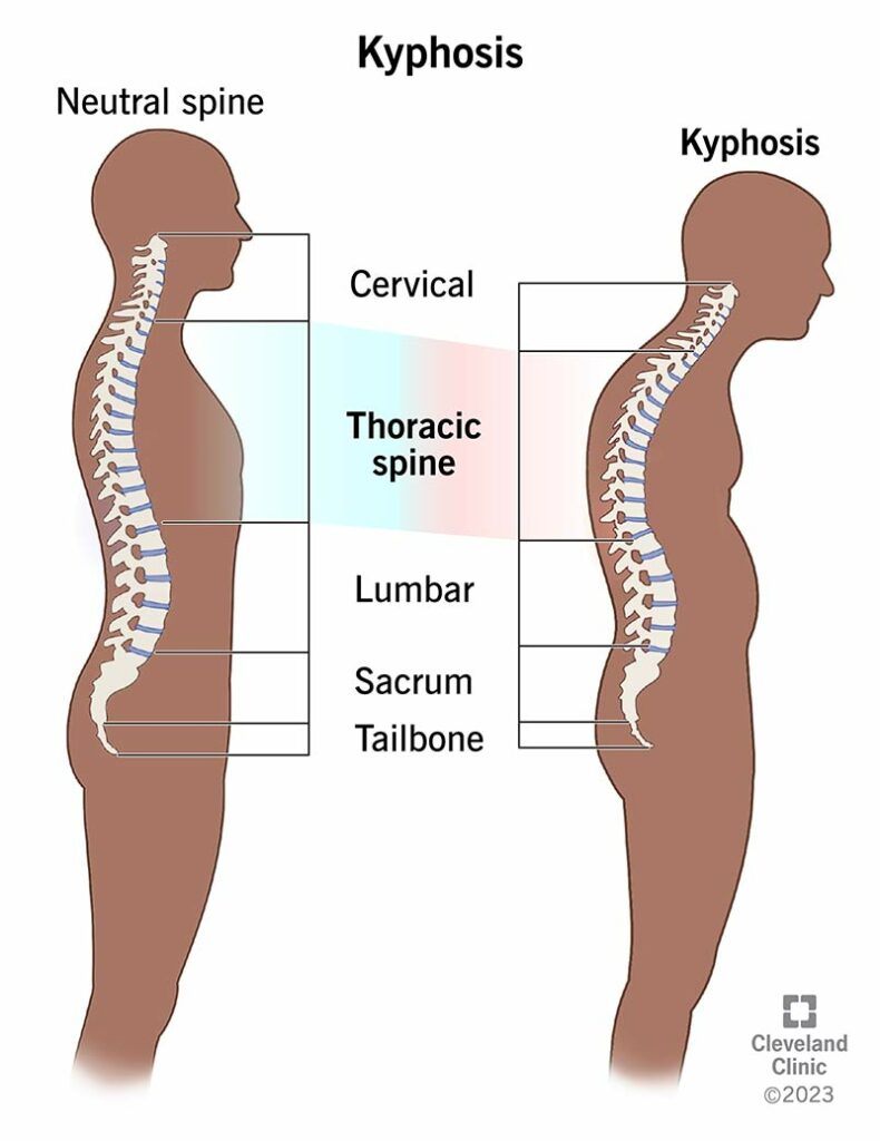 17671 kyphosis