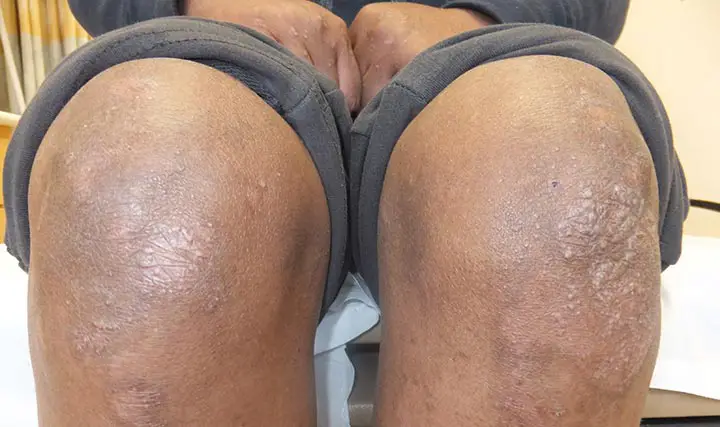 17792 epidermolysis bullosa knees