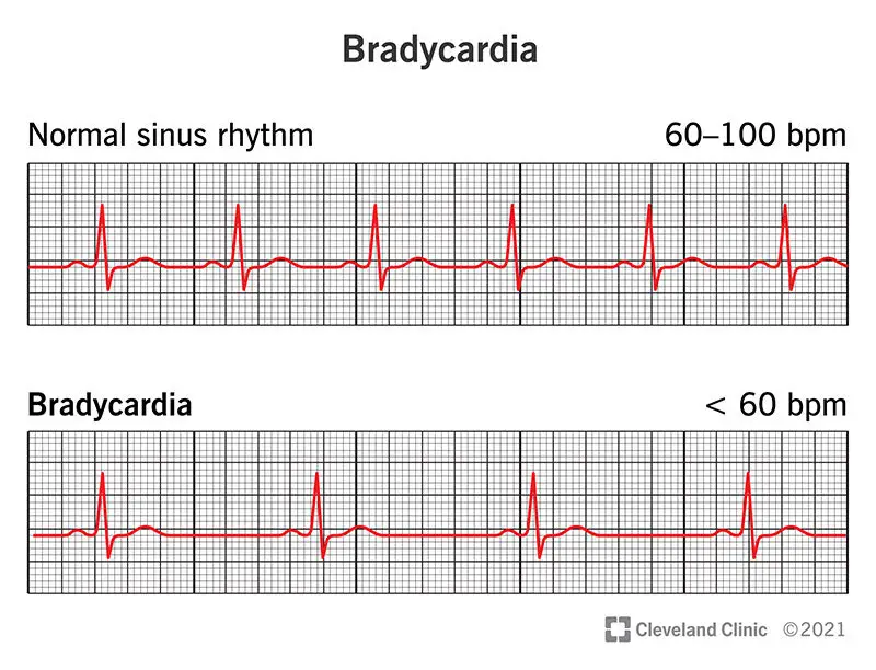 17841 bradycardia