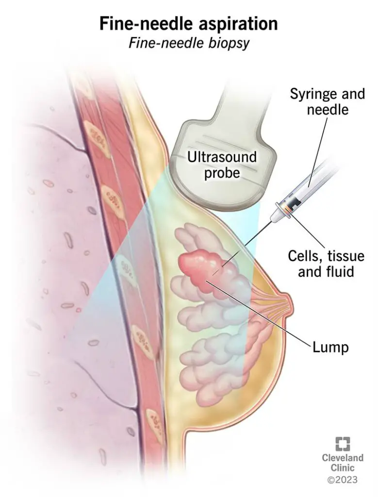 17872 fine needle aspiration fna