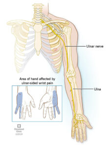 21035 ulnar wrist pain