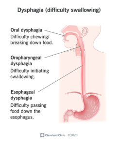 21195 dysphagia difficutly swallowing