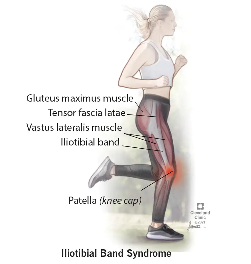 21967 Iliotibial band syndrome