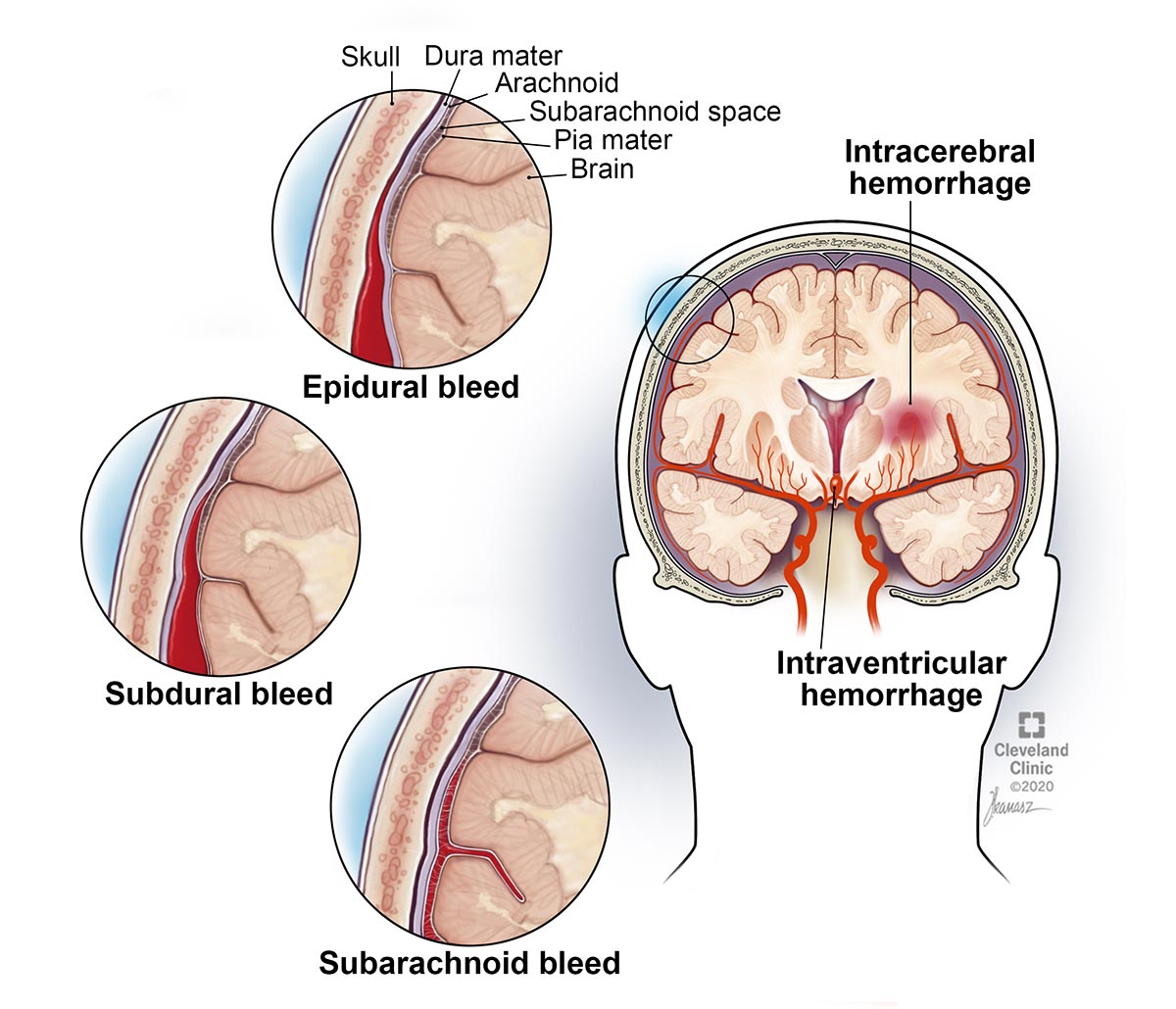 Epidurinė hematoma yra smegenų kraujavimas tarp kaukolės ir smegenis dengiančios membranos.