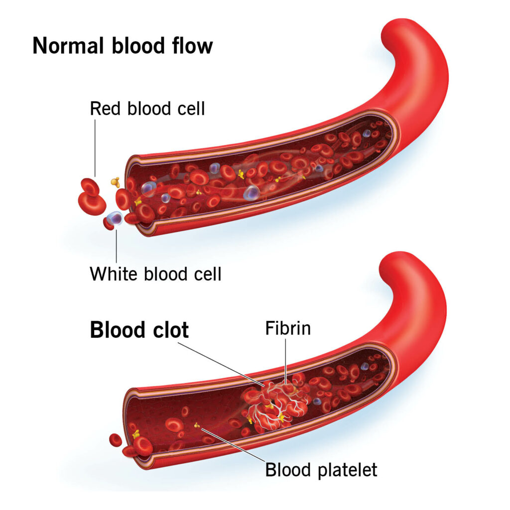 22045 d dimer test blood clot final