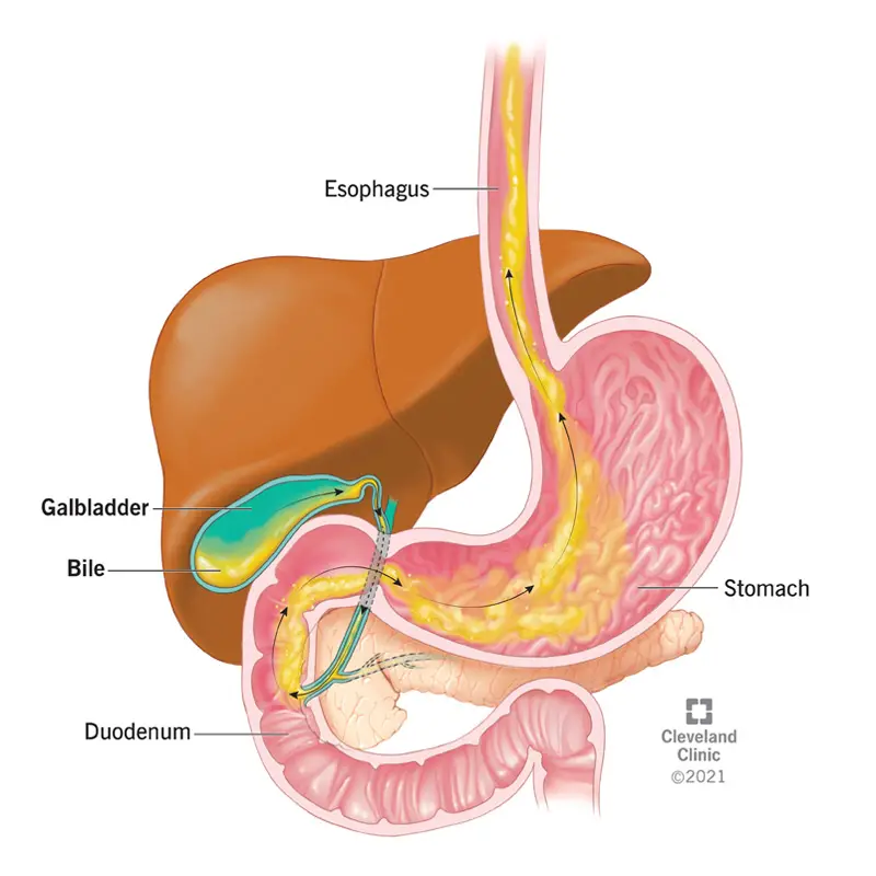 22056 bile reflux