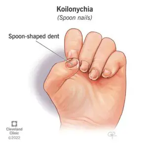 22140 koilonychia spoon nails