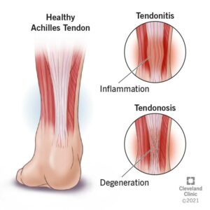 22289 tendinopathy