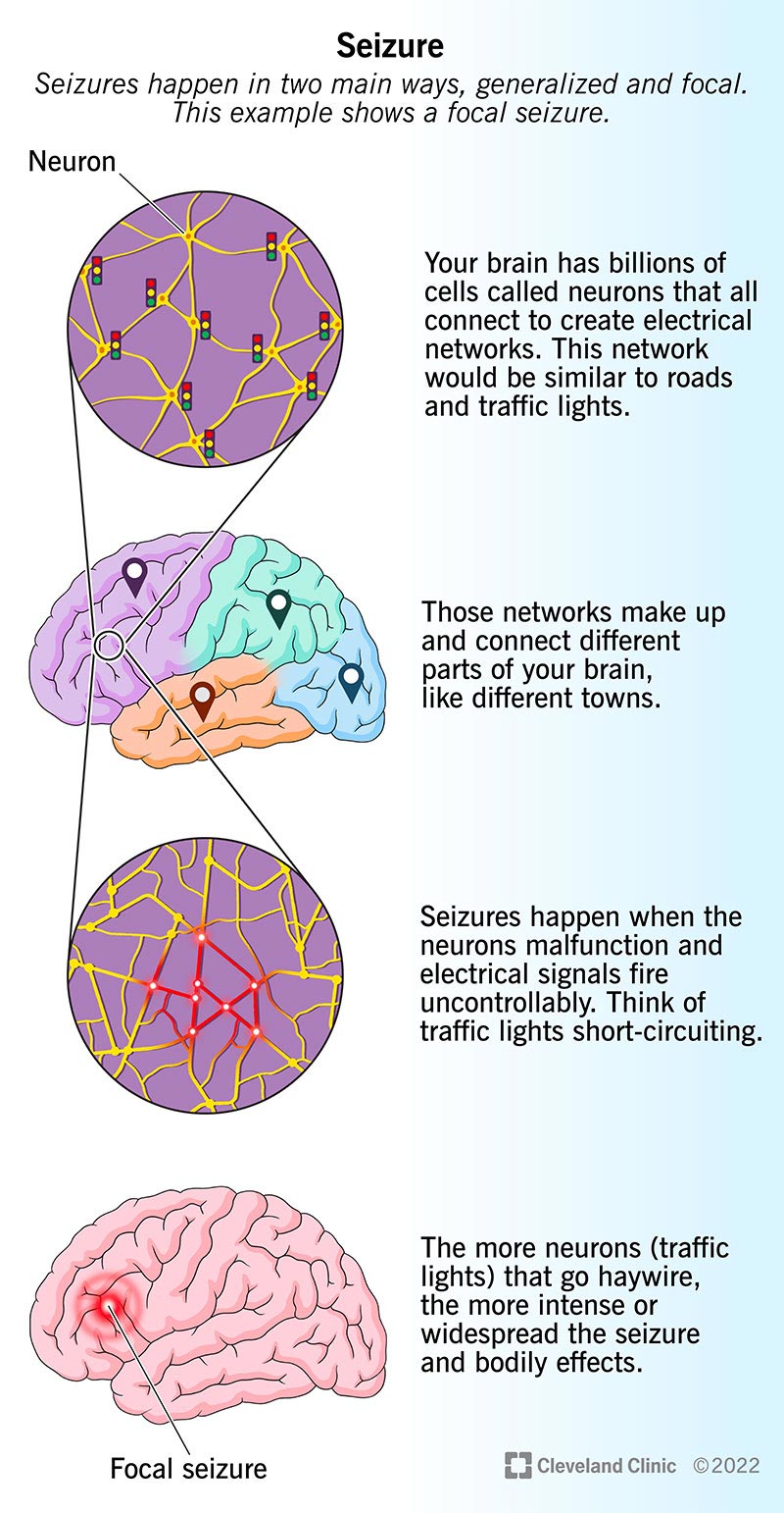 Neuroniniai tinklai jūsų smegenyse perduoda signalus.  Priepuoliai sutrikdo šį elektros srautą.