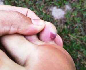 22994 blood blister