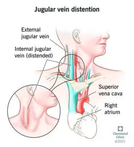 23149 jugular vein distention 2