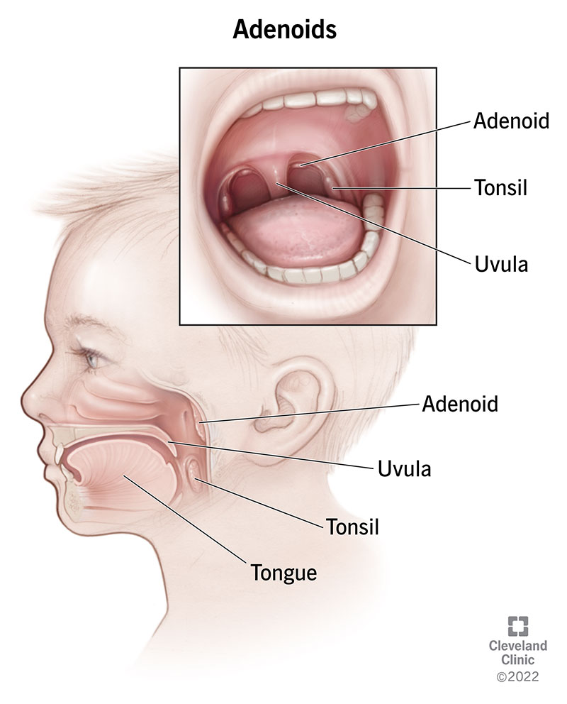 23181 adenoids