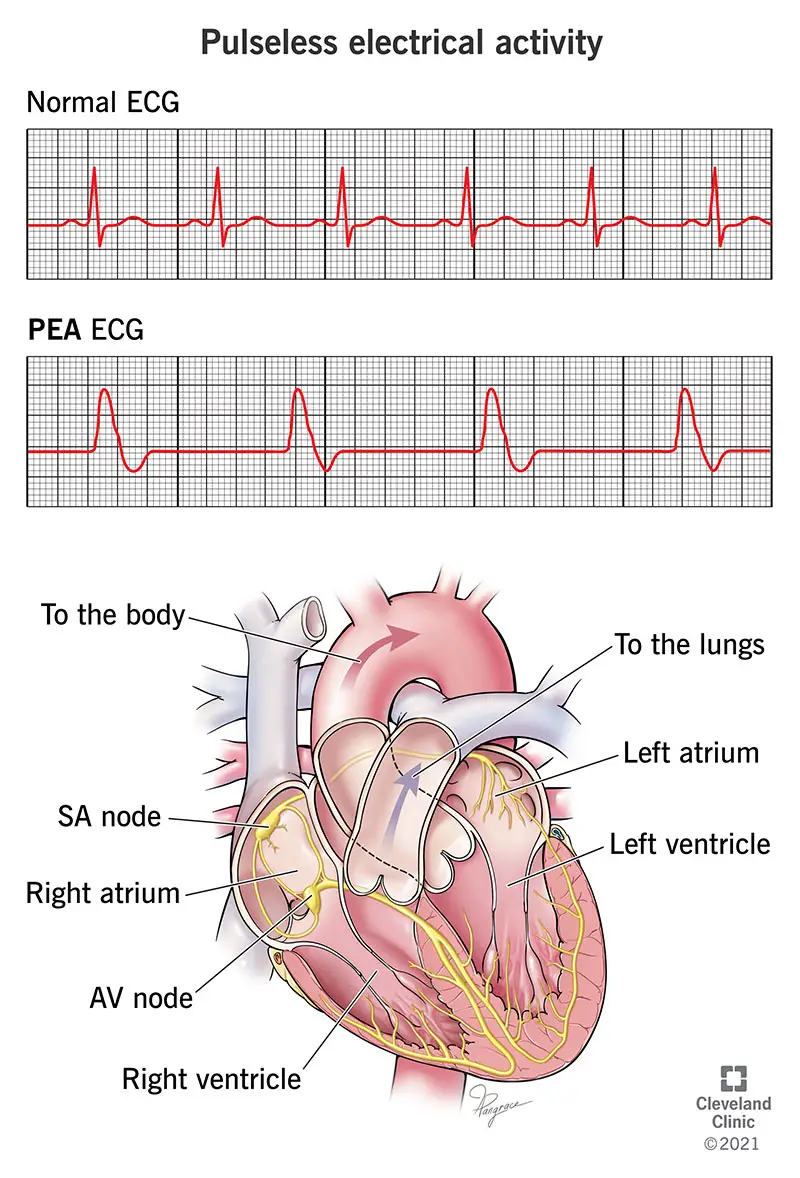 EKG, iliustruojantis impulsinį elektrinį aktyvumą (PEA)