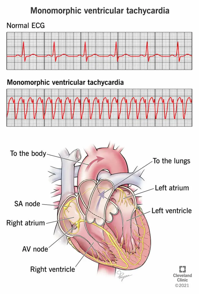 23215 monomorphic ventricular tachycardia