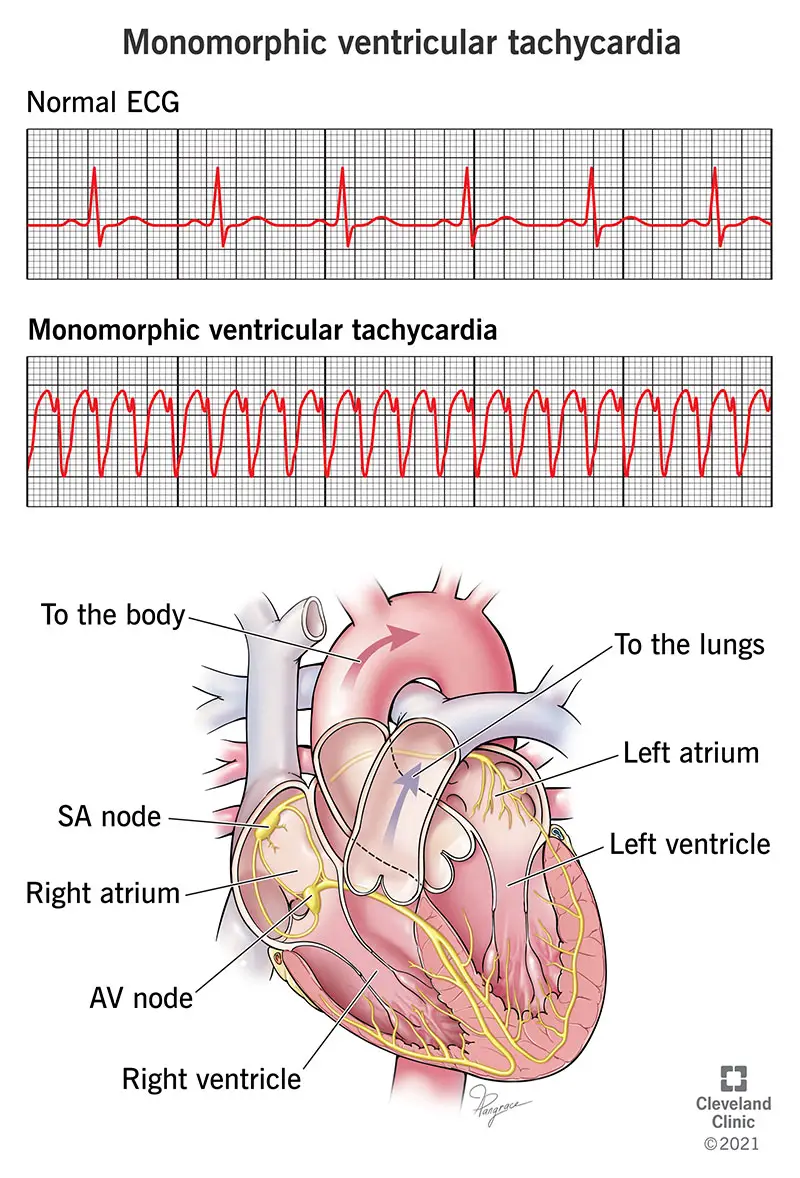 EKG rodo monomorfinę skilvelinę tachikardiją.