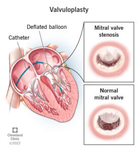 23277 valvuloplasty