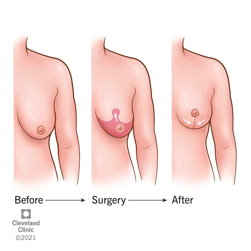 23298 breast lift