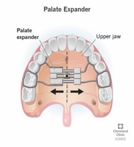 23502 palate expander