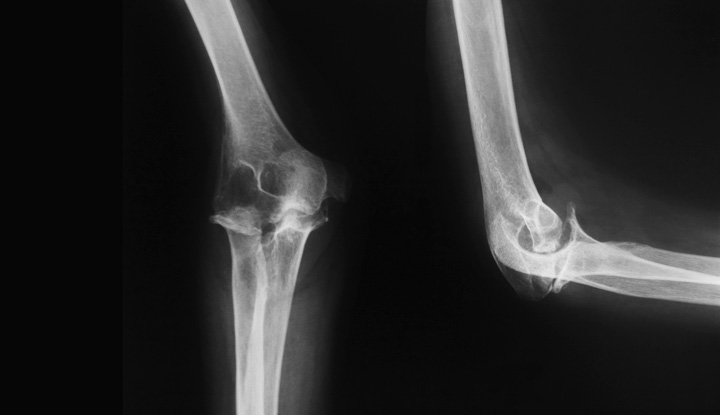 23507 elbow x ray