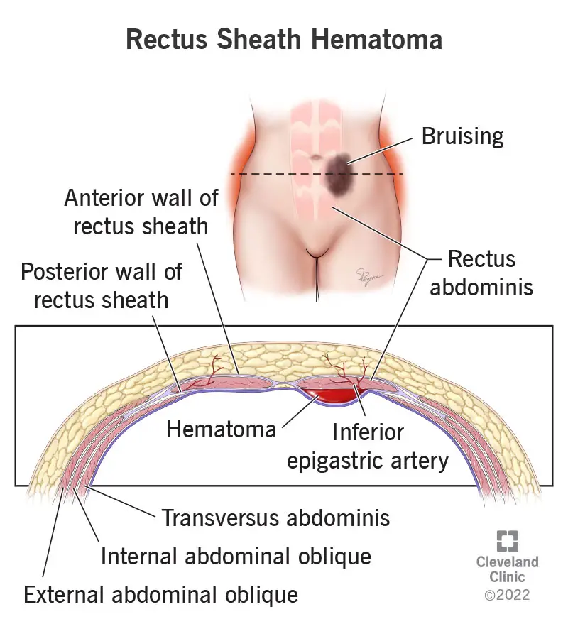 23934 rectus sheath hematoma