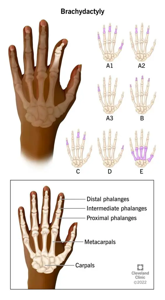 24081 brachydactyly