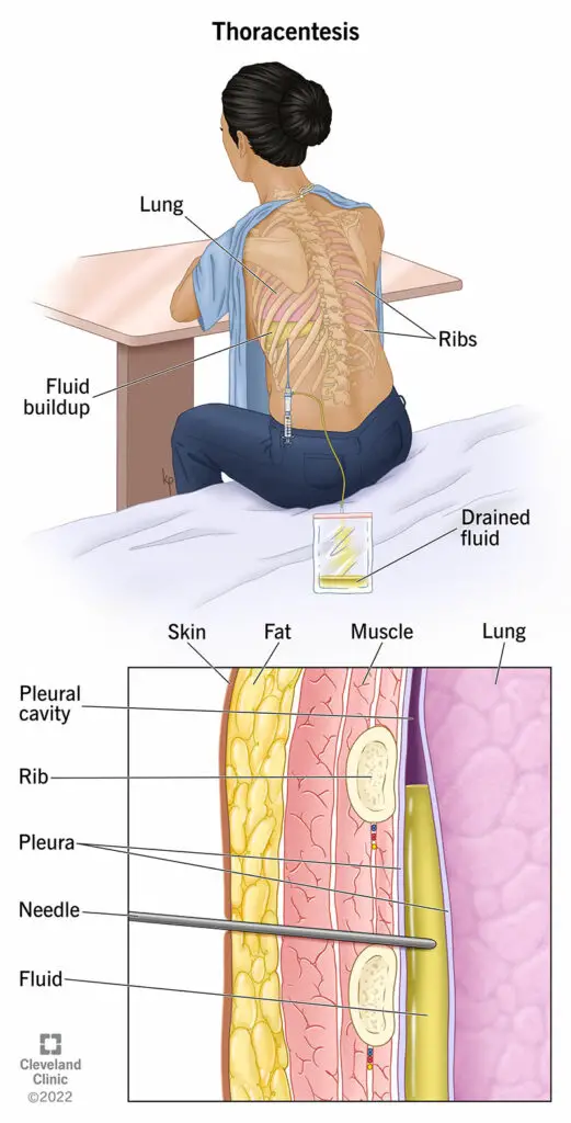 24254 thoracentesis