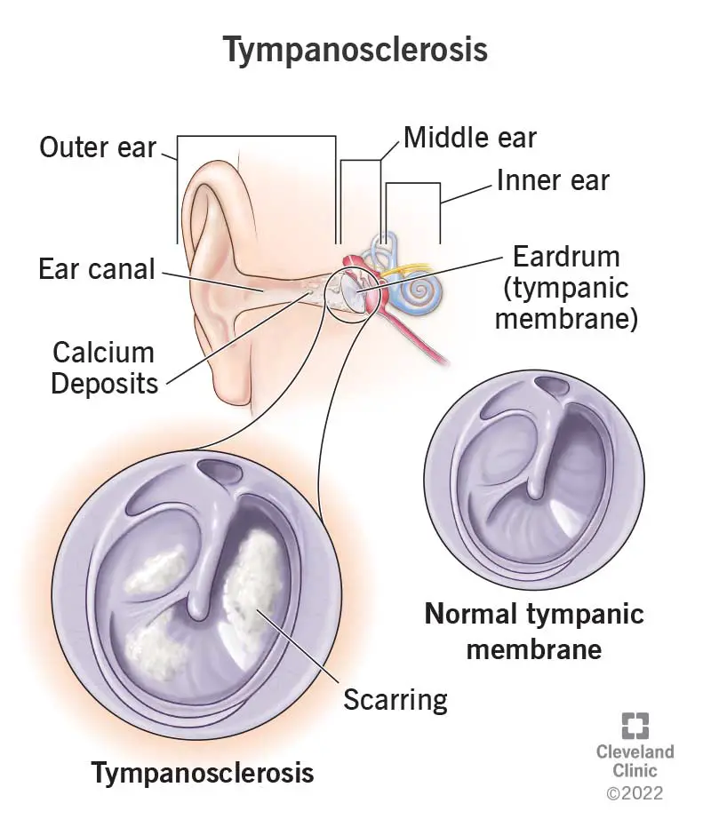 24265 tympanosclerosis