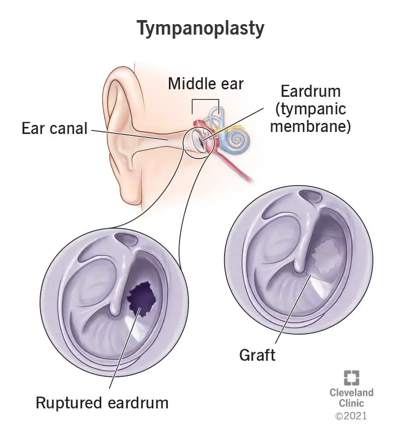 24406 tympanoplasty