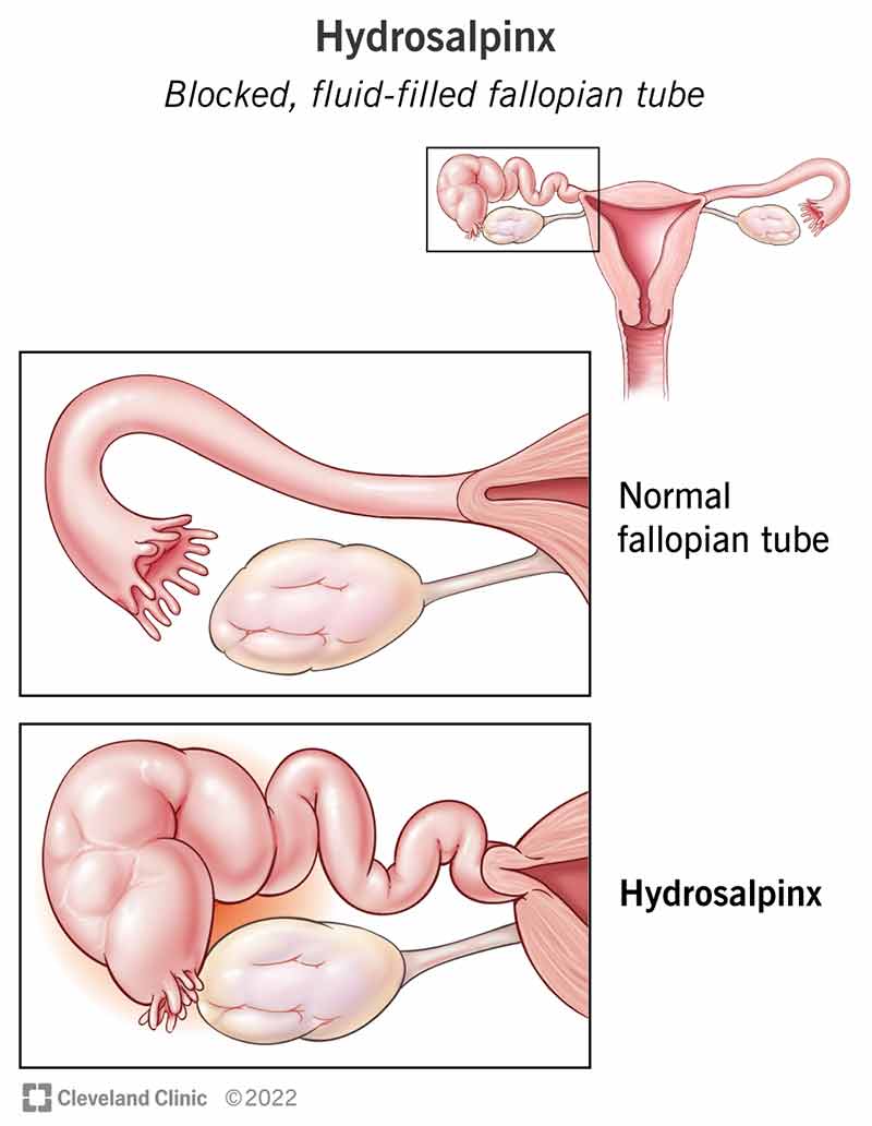 Normalaus atviro kiaušintakio ir užsikimšusio vamzdelio su hidrosalpinksu palyginimas