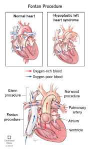 24545 fontan procedure