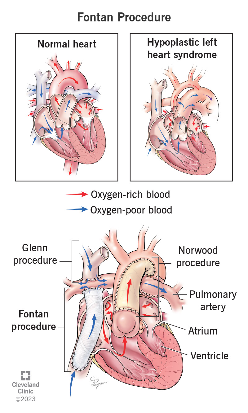 Fontano procedūra leidžia deguonies stokojančiam kraujui iš apatinės kūno dalies patekti į plaučių arteriją, aplenkiant širdį.