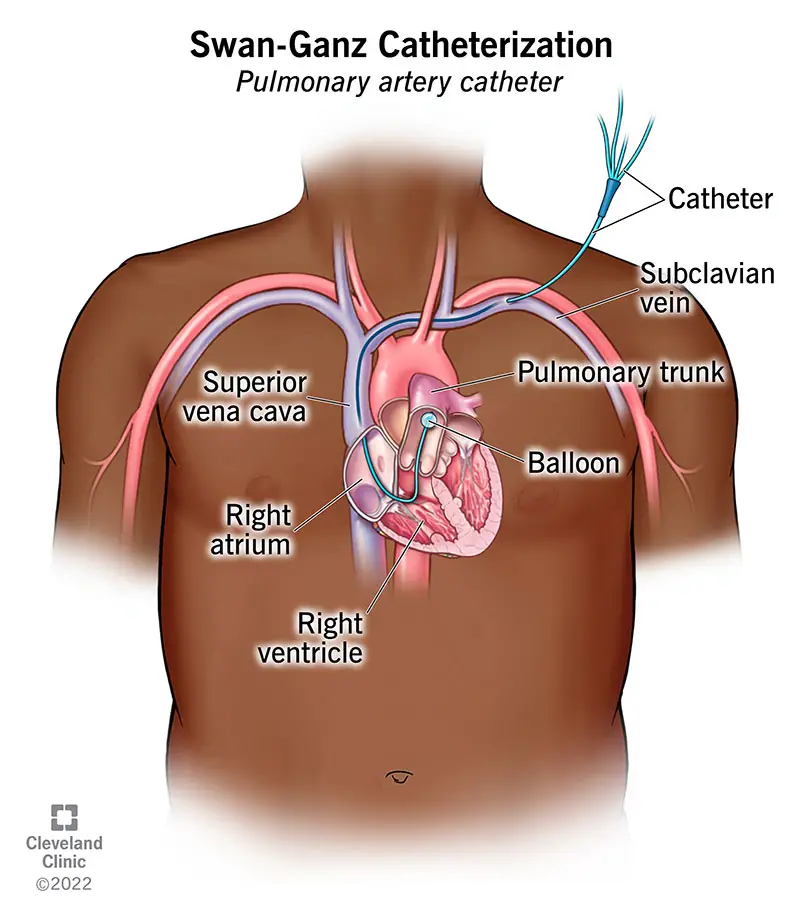 24606 swan ganz catheter