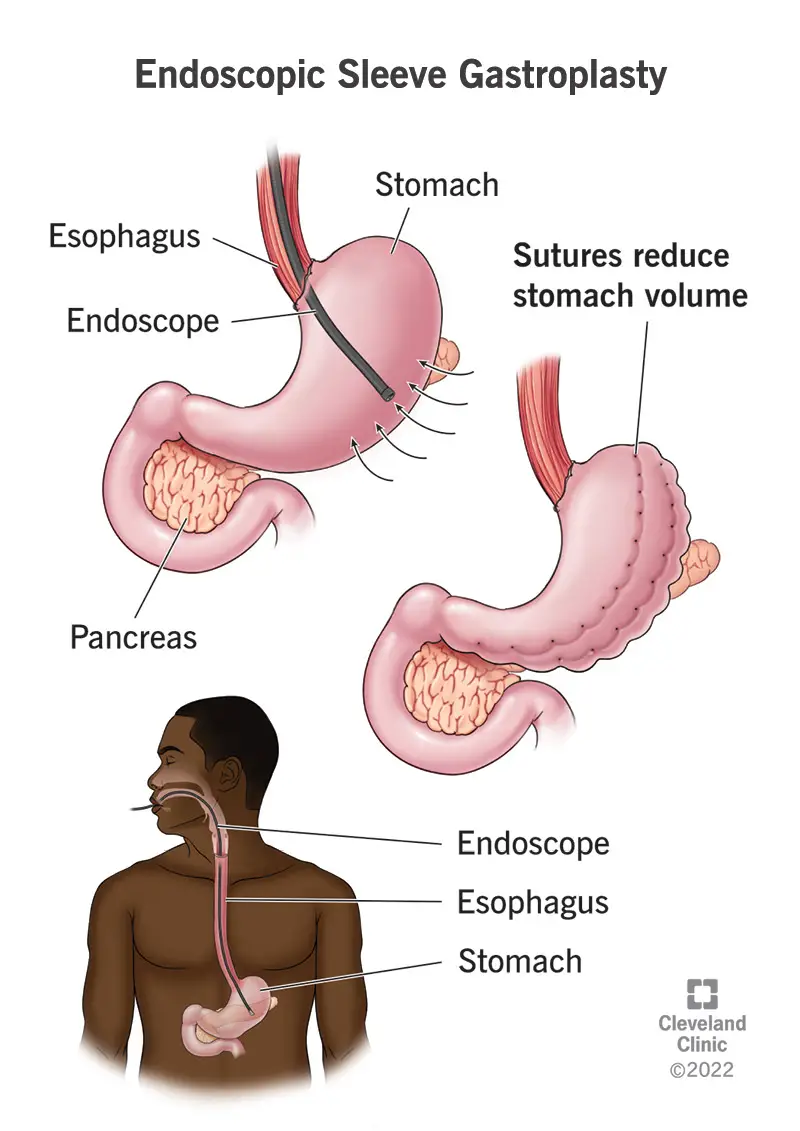 Endoskopinė rankovių gastroplastika sumažina skrandžio tūrį, uždarant dalį siūlėmis.