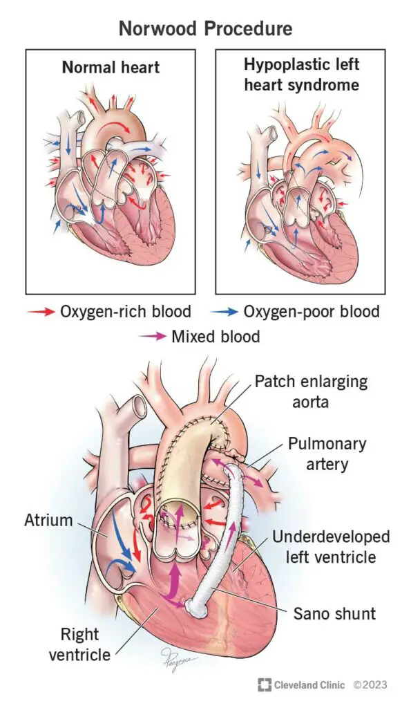 24794 norwood procedure