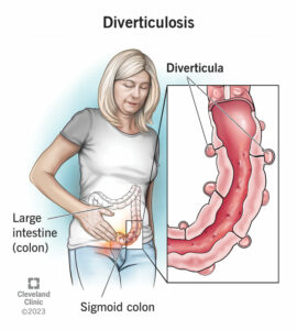 24883 diverticulosis