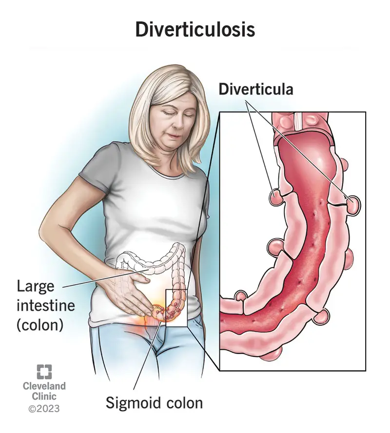 24883 diverticulosis