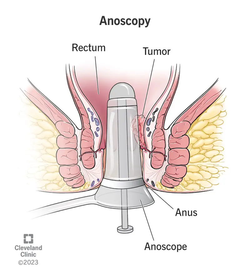 24993 anoscopy