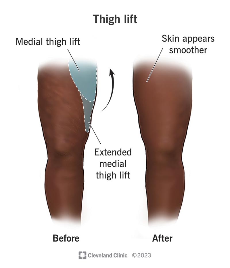 25012 thigh lift thighplasty