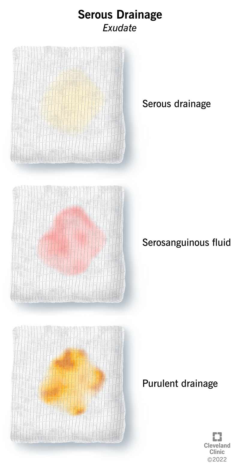 Trijų žaizdų tvarsčių su seroziniu drenažu ir kitų rūšių eksudatu iliustracija.