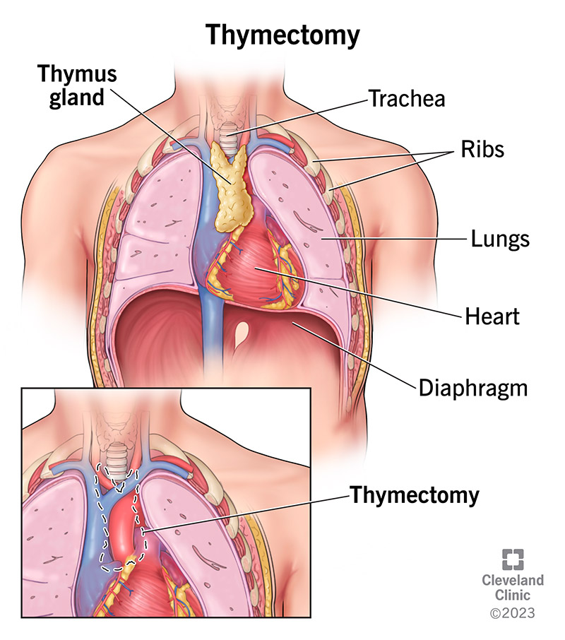 25041 thymectomy illustration