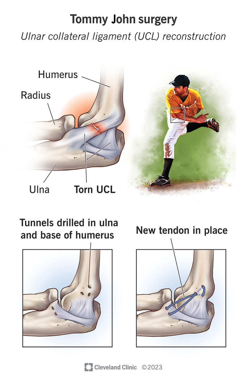 Tommy John operacija pataiso alkūnkaulio šoninio raiščio plyšimą.