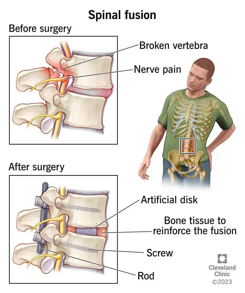 25168 spinal fusion