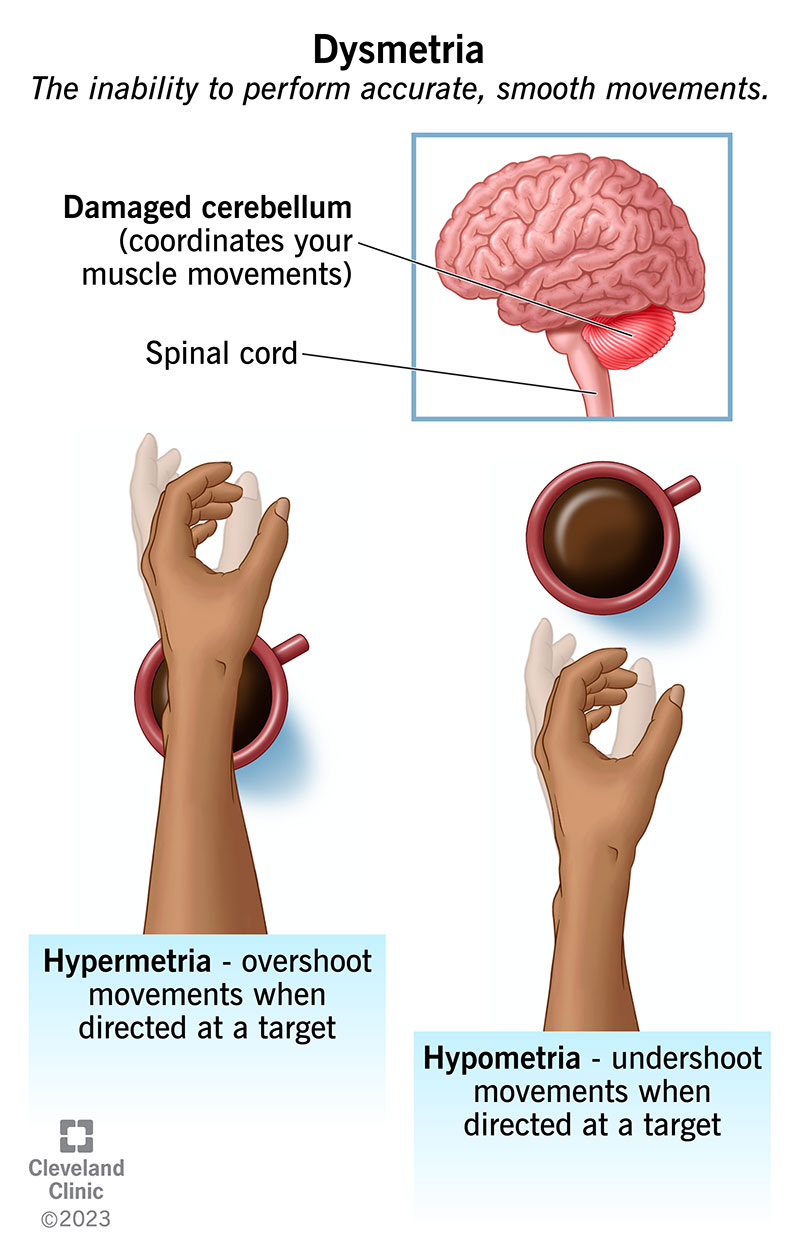Dismetrija: rankos peršokimas (hipermetrija) ir nepakankamas šovimas (hipometrija), siekiantis kavos puodelį.