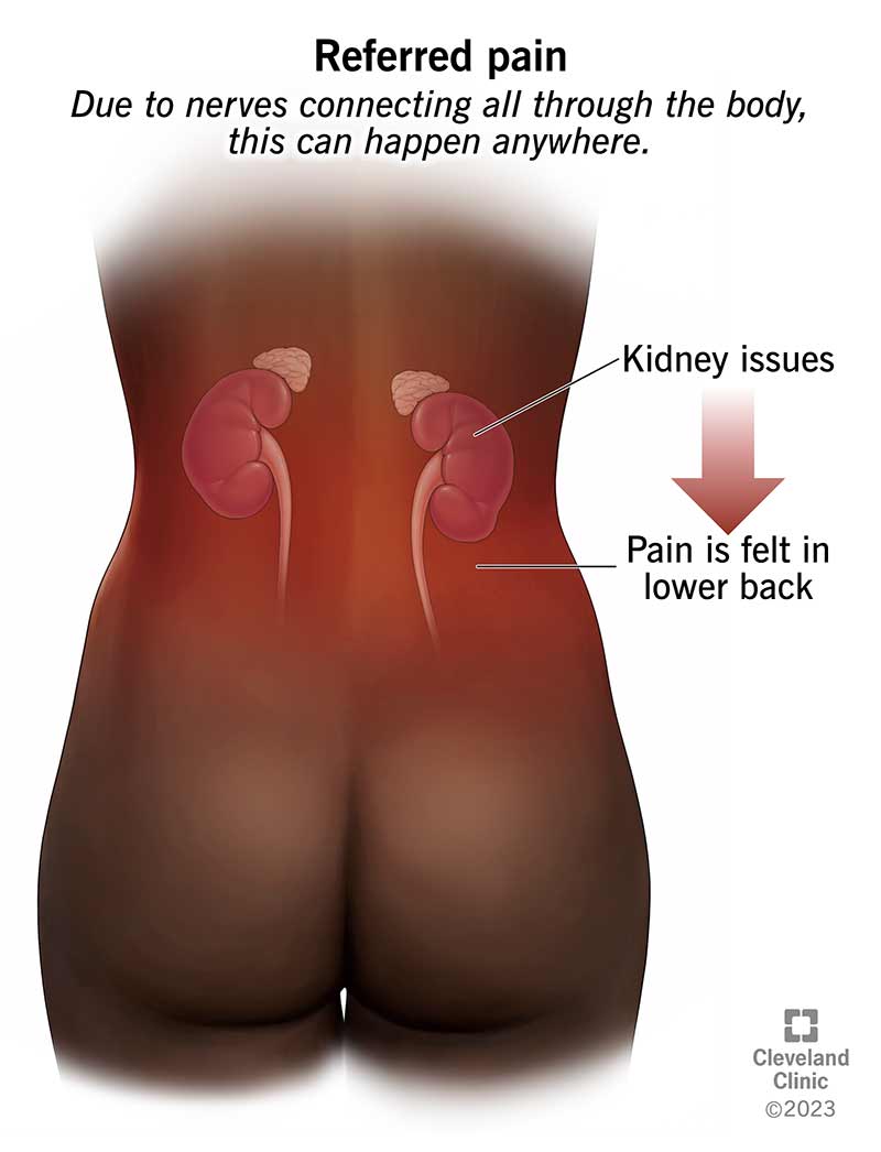 Diagrama, kurioje parodyta inkstų vieta (nugaros viduryje) ir vieta, kur jaučiamas nurodytas skausmas (apatinė nugaros dalis).