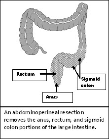 abdominoperinealinė rezekcija