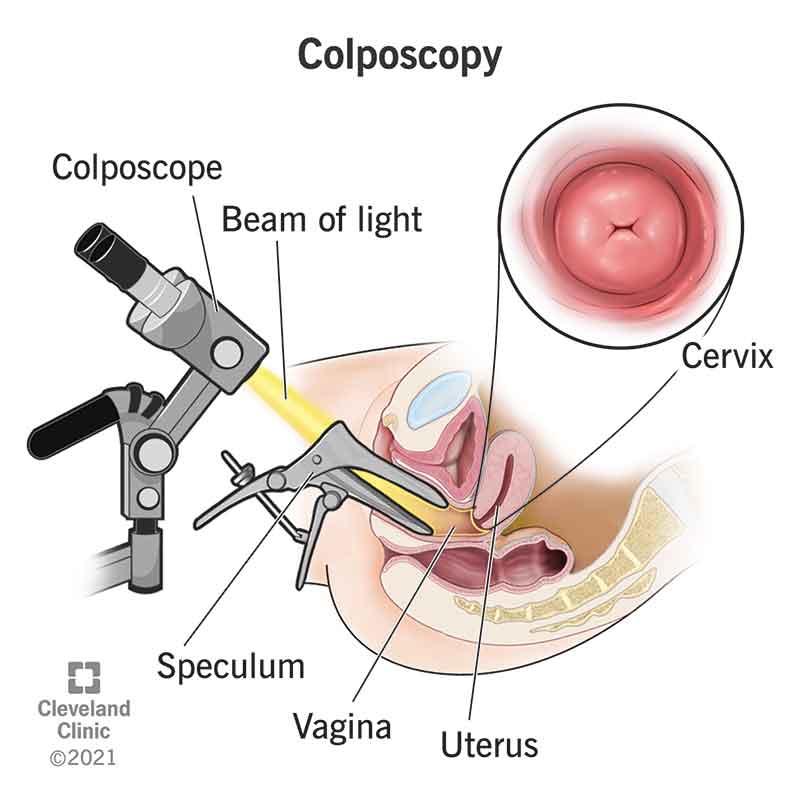 4044 colposcopy