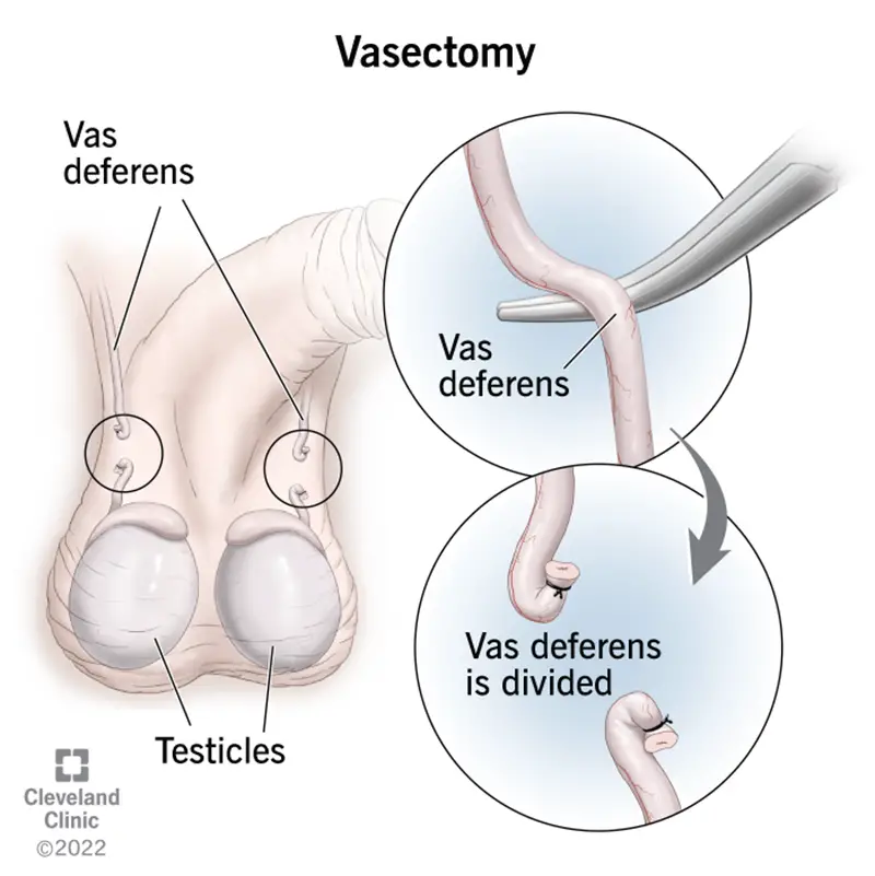 4423 vasectomy